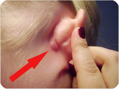 huvudvärk bakom örat