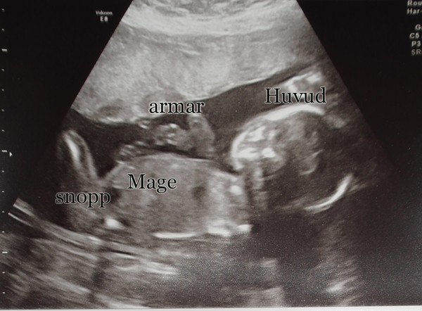 Dating graviditet med hjälp av ultraljud