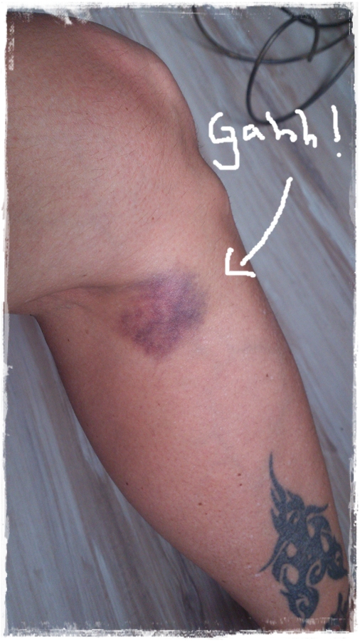 Bild på blodpropp i benet