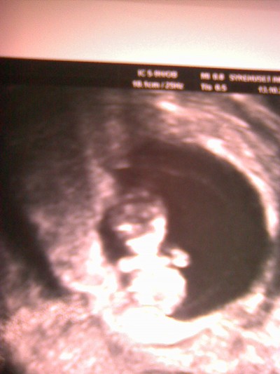 Här är min första ultraljuds bild, bebisen är 10 v. man kan se huve å armar å magen, bena kom inte me:)