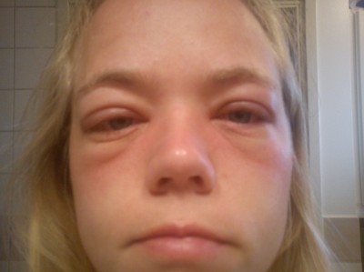 svullna ögon allergi