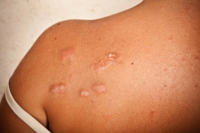 Steroid injections for keloids on chest