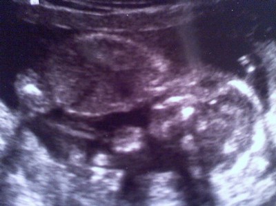 Bild på bebisen :) ! , det va i ungefär vecka 15 när jag gjorde ultraljud !